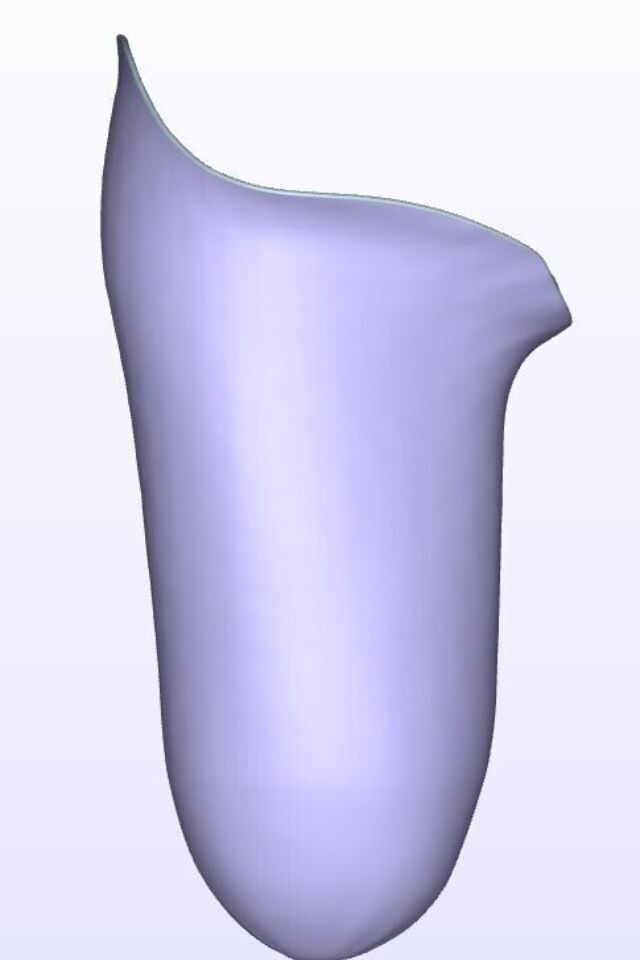 Mild IC Anterior