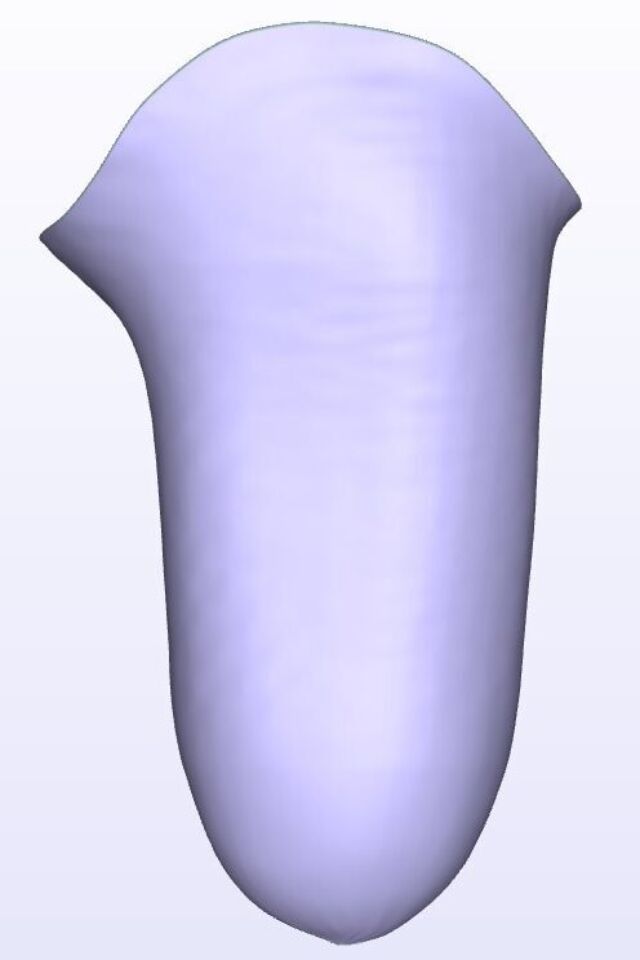Mild IC Lateral