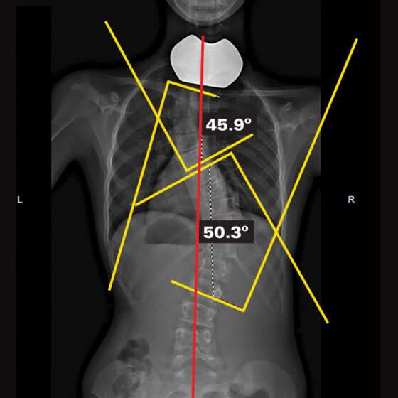 Original - Out Of Brace X-Ray
