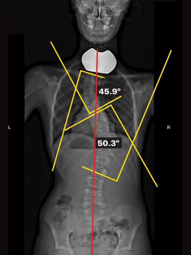 Original - Out Of Brace X-Ray