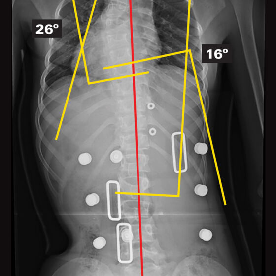 In-Brace X-Ray (Supine)