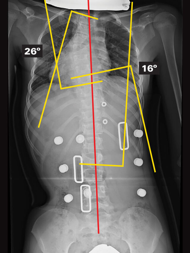 In-Brace X-Ray (Supine)