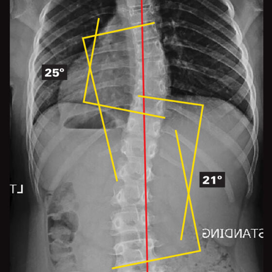 Original - Out Of Brace X-Ray