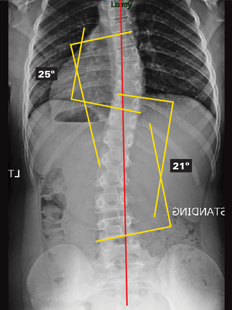 Original - Out Of Brace X-Ray