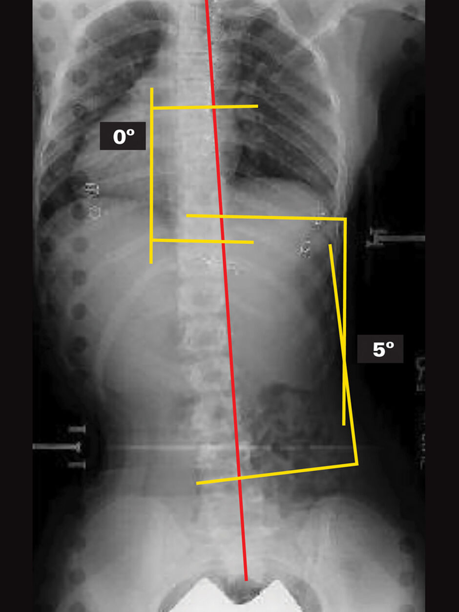 On Board X-Ray (Supine)