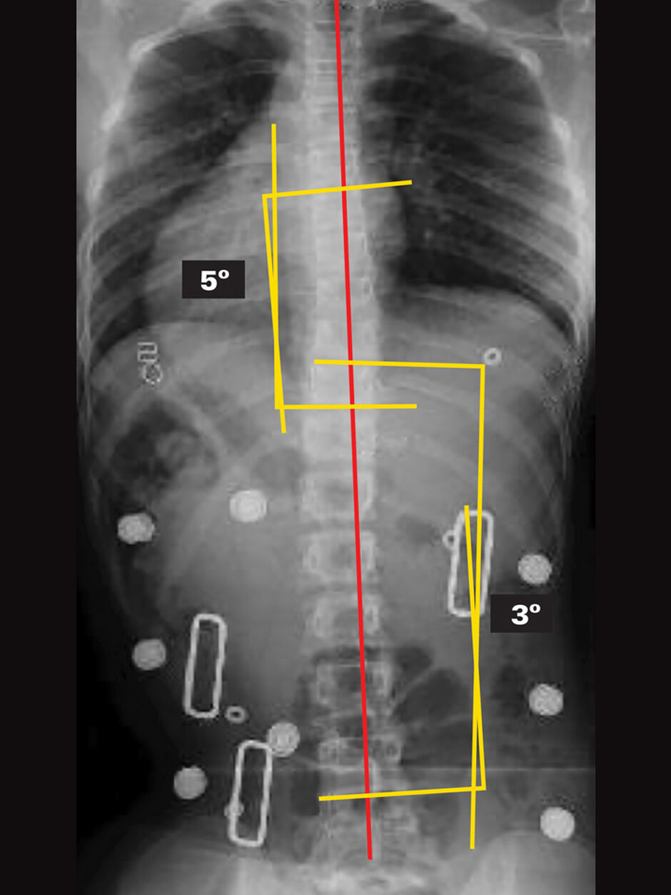 In-Brace X-Ray (Supine)