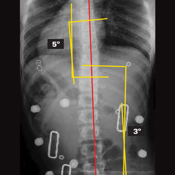 In-Brace X-Ray (Supine)