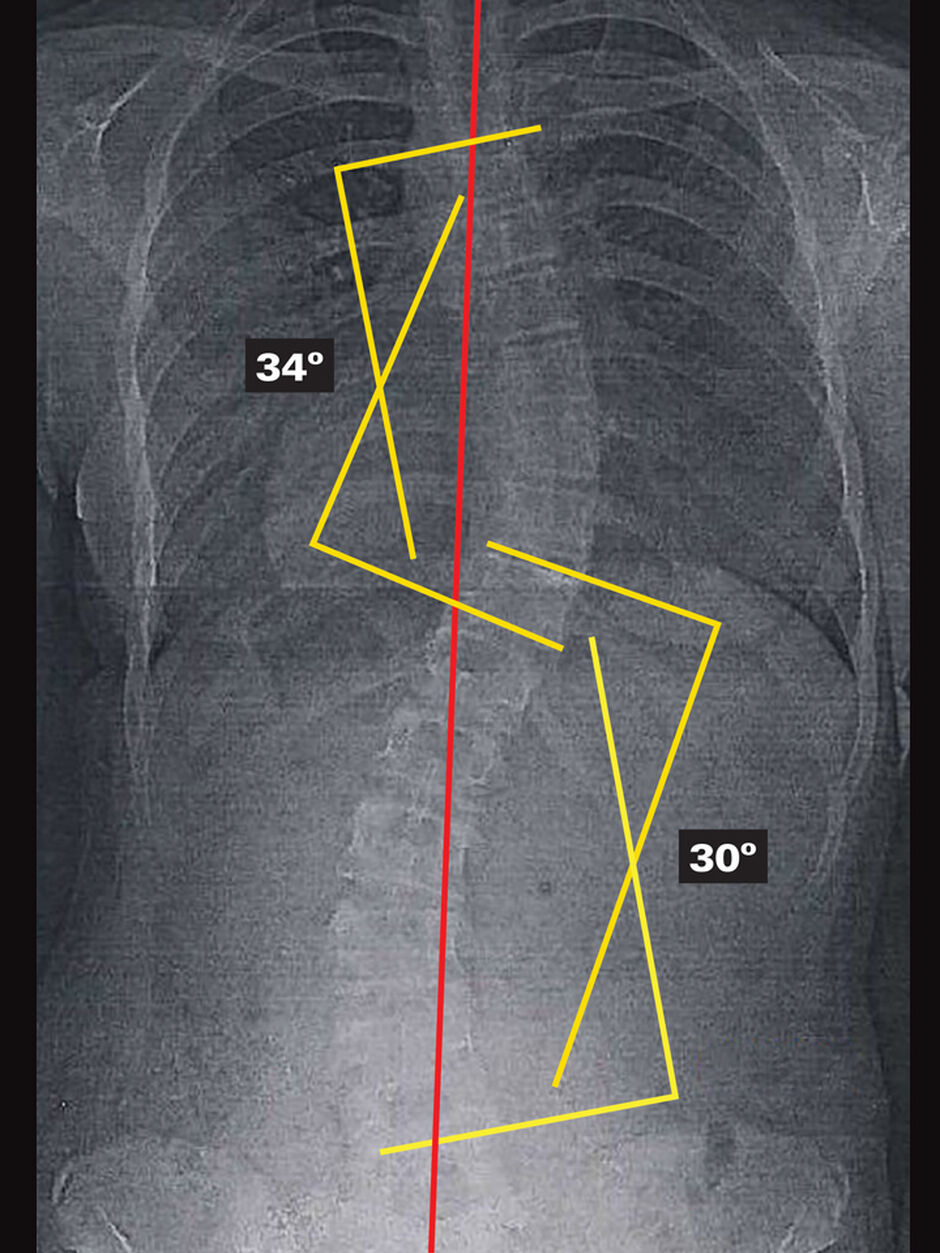 Original - Out Of Brace X-Ray