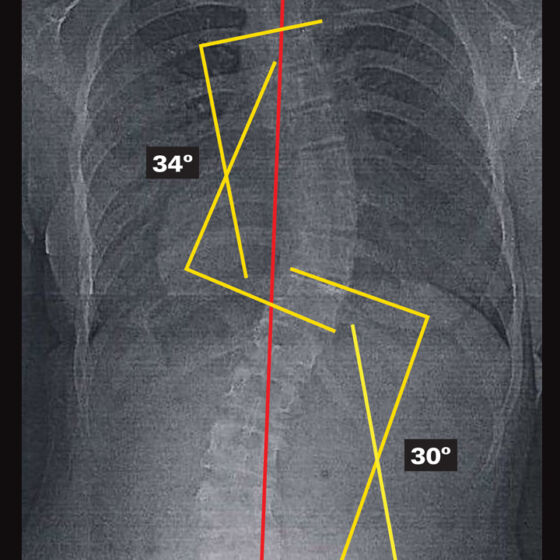Original - Out Of Brace X-Ray