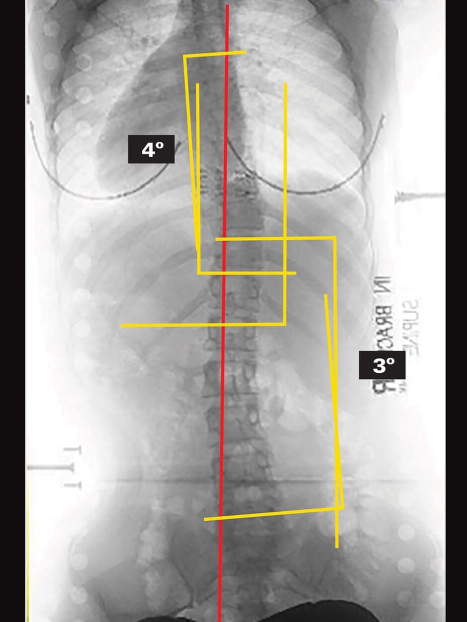 On Board X-Ray (Supine)