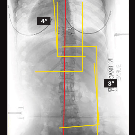 On Board X-Ray (Supine)