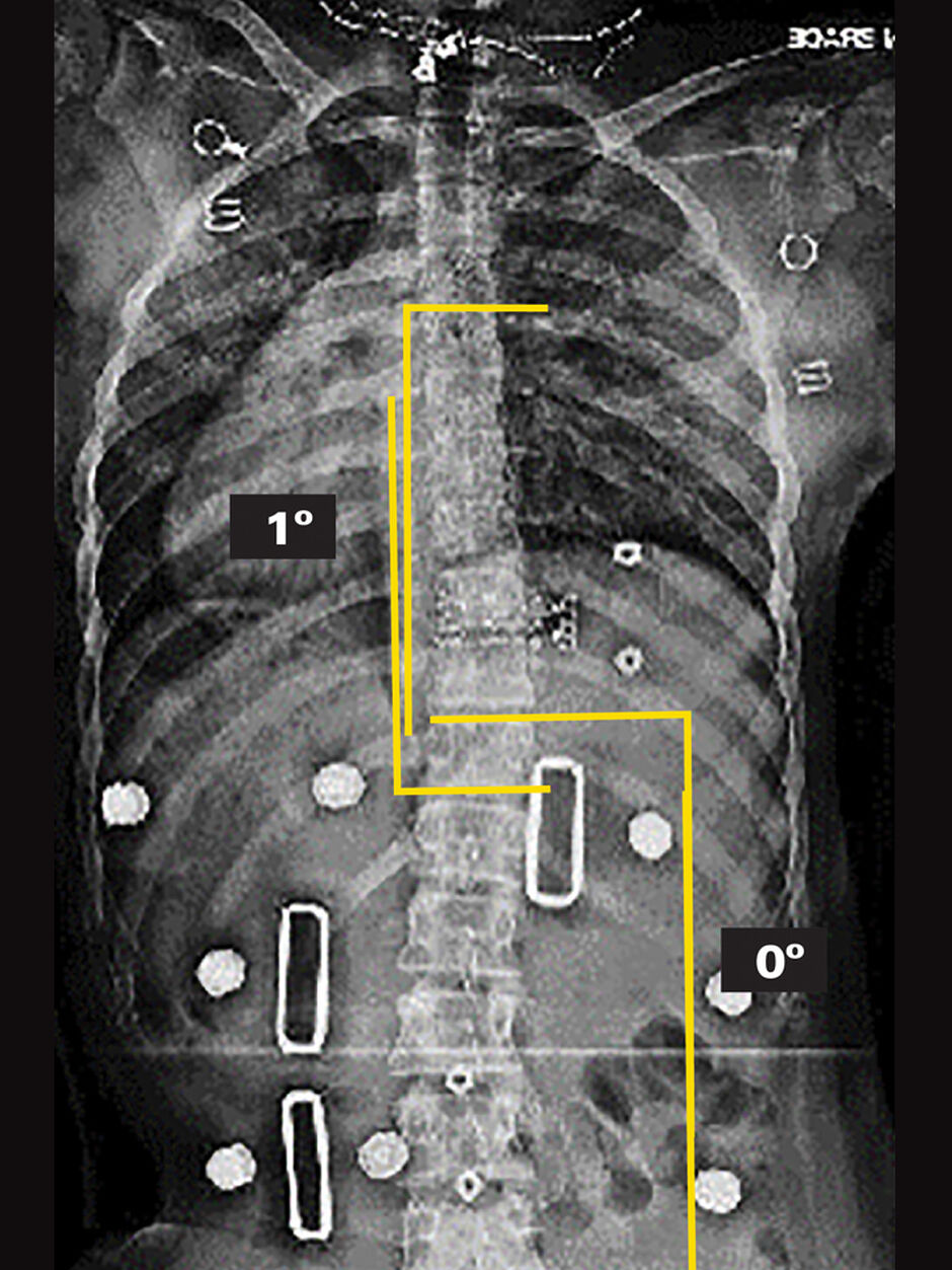 In-Brace X-Ray (Supine)