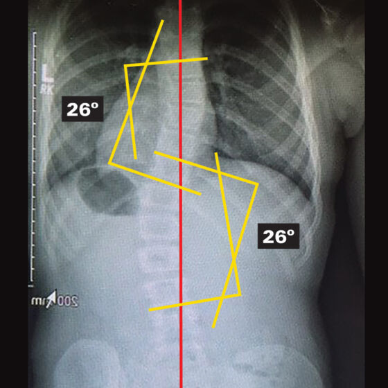 Original - Out Of Brace X-Ray