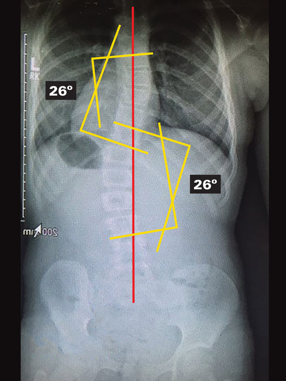 Original - Out Of Brace X-Ray