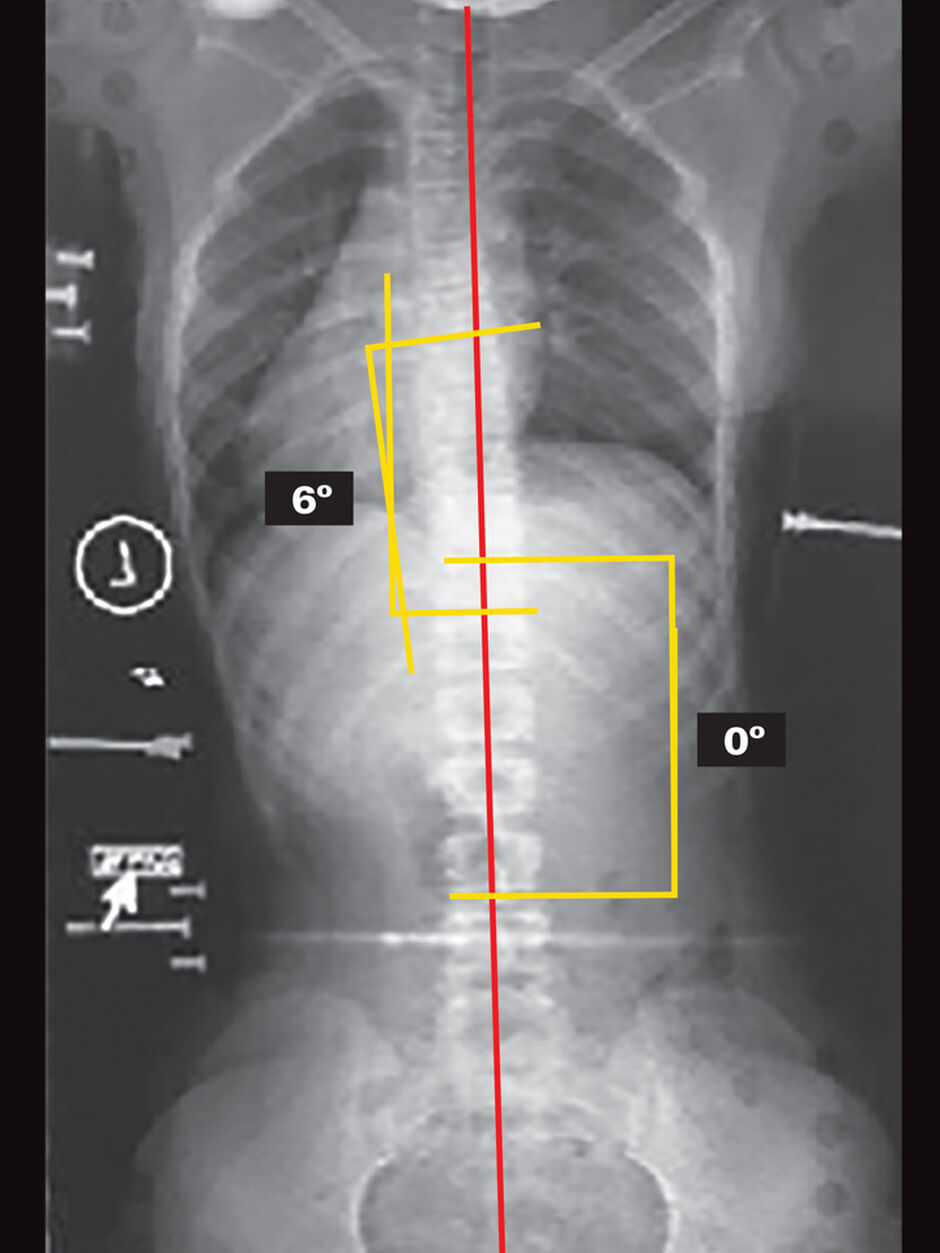 On Board X-Ray (Supine)