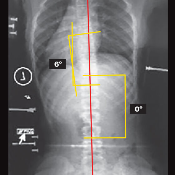 On Board X-Ray (Supine)