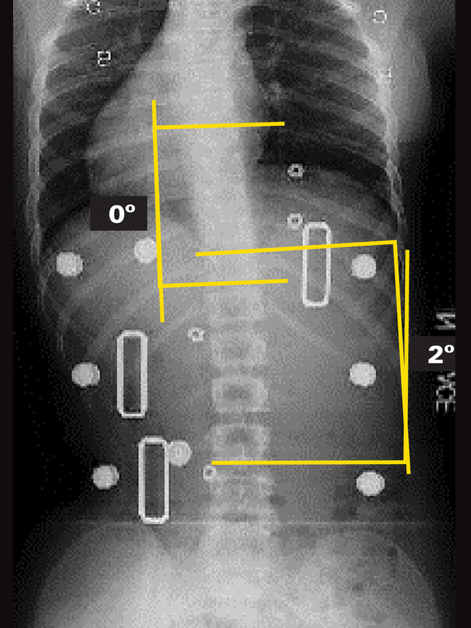 In-Brace X-Ray (Supine)