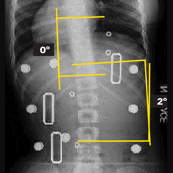 In-Brace X-Ray (Supine)