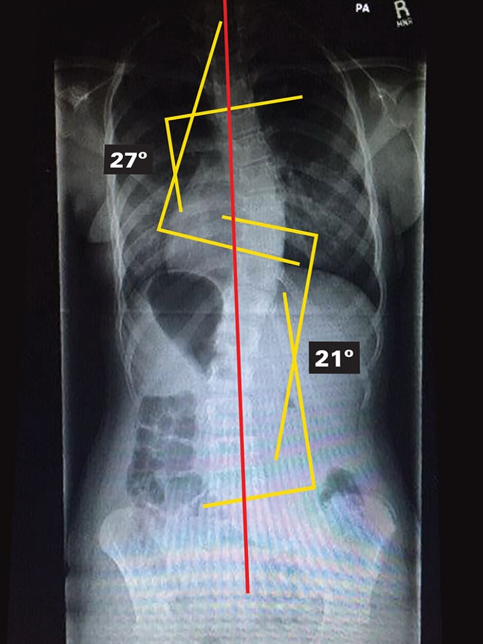 Out Of Brace X-Ray