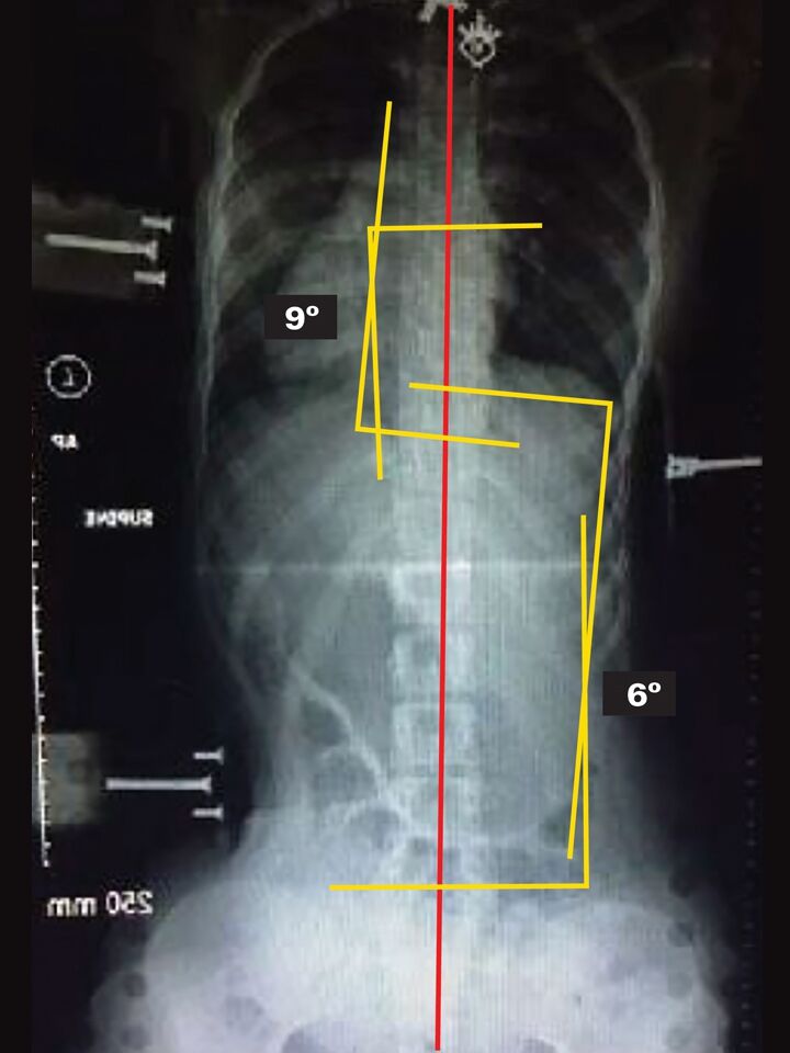 Patient On Board- X-Ray