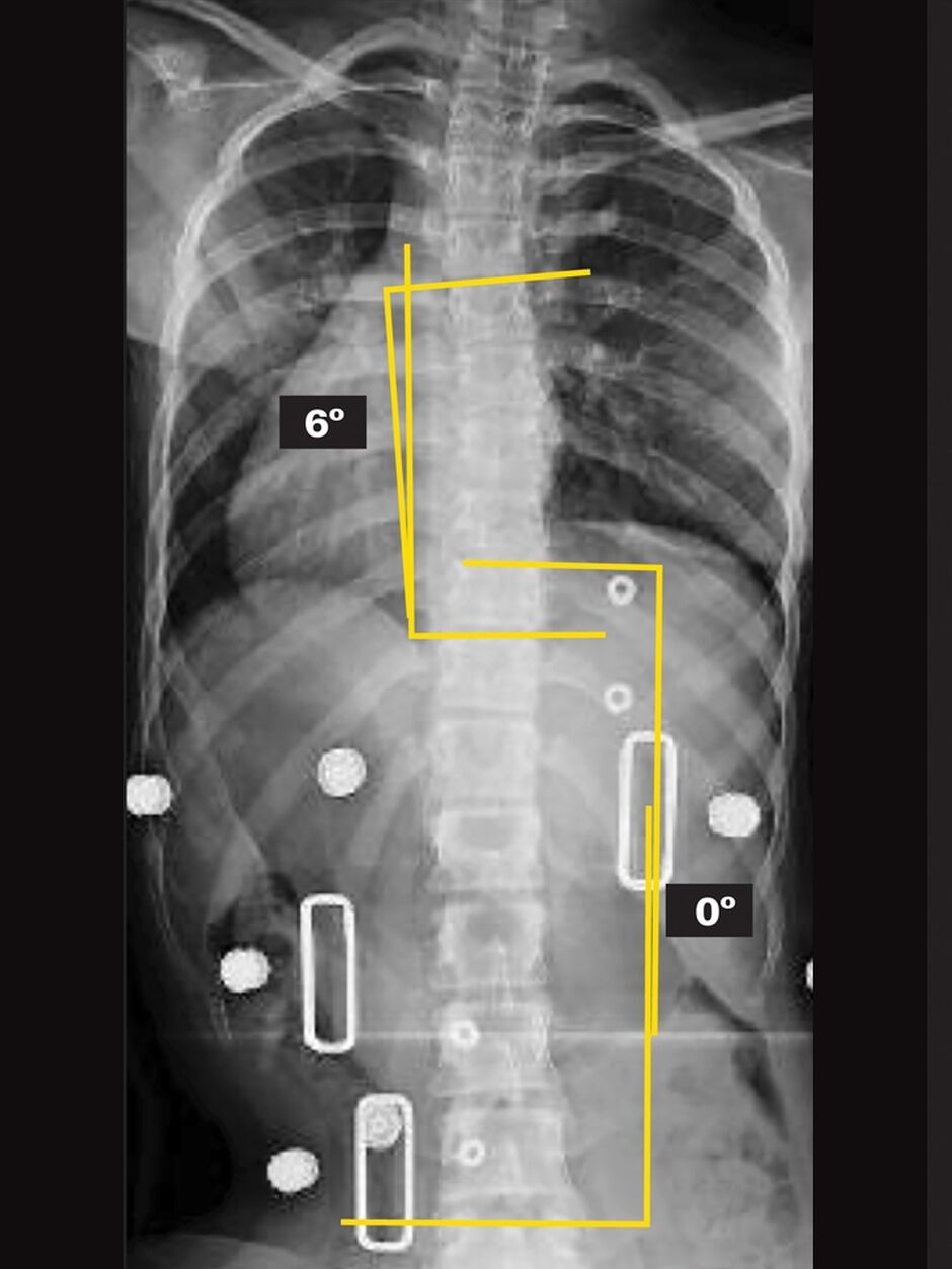 Patient In-Brace X-Ray