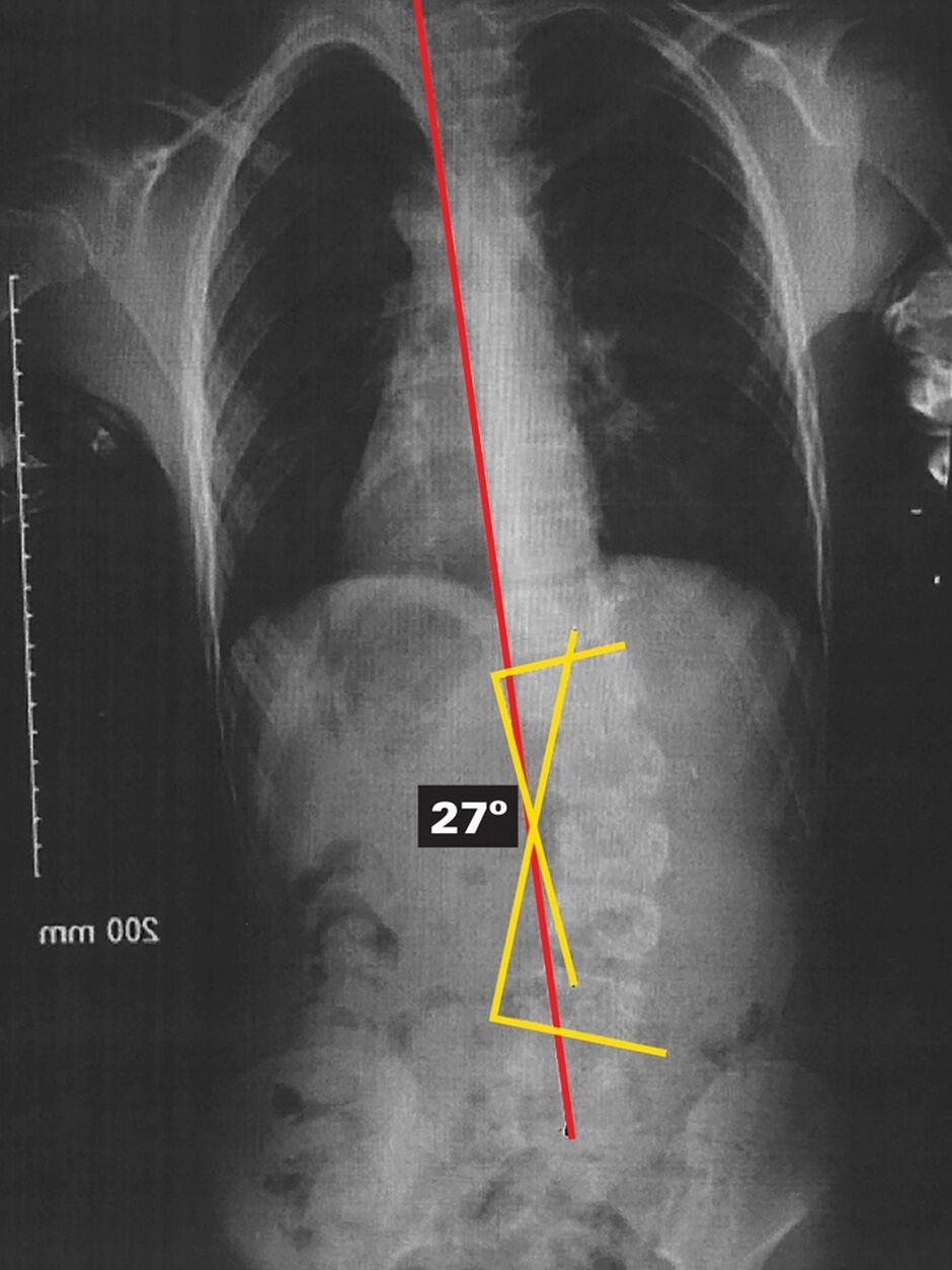 Original Out Of Brace X-Ray