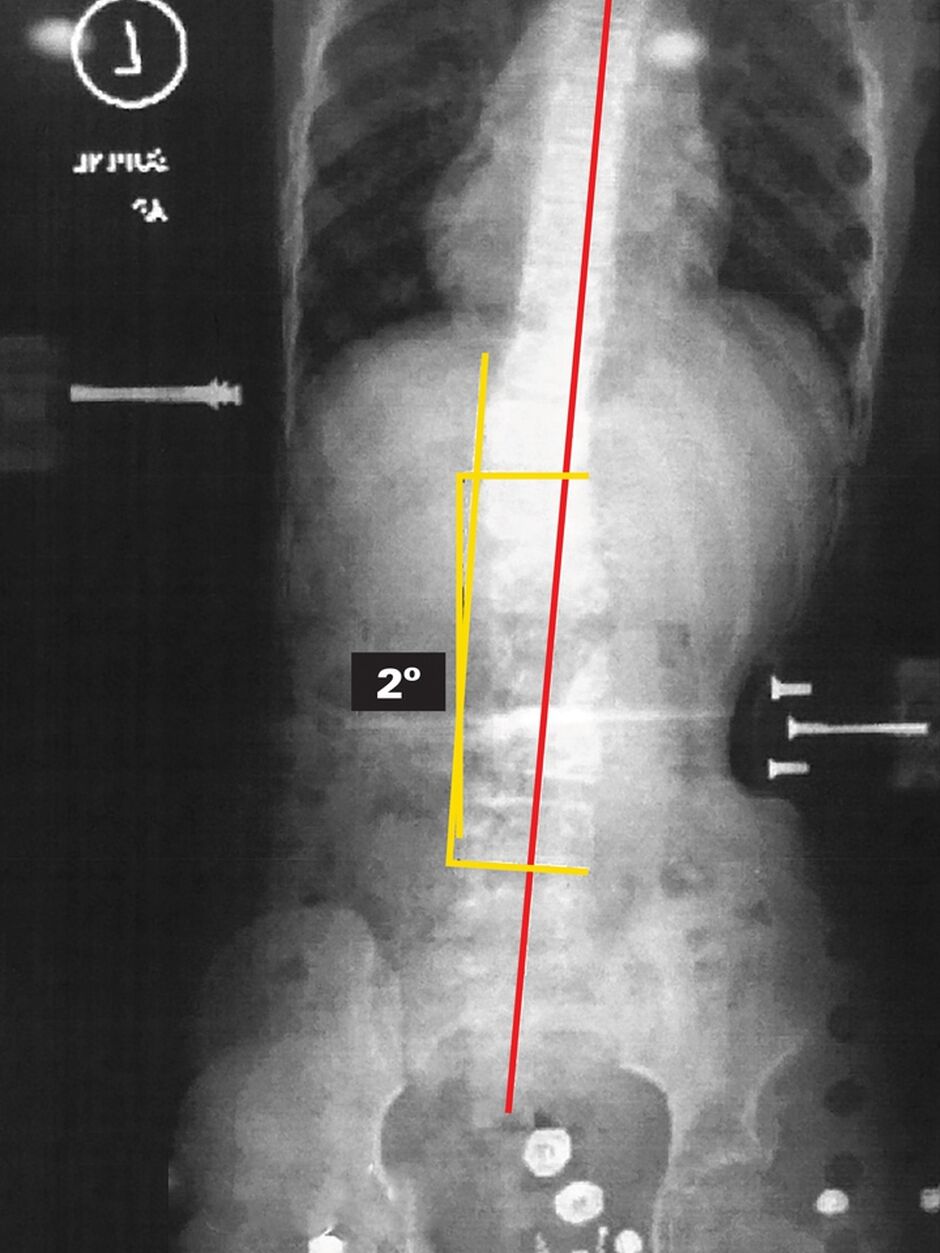 Patient On Board Xray