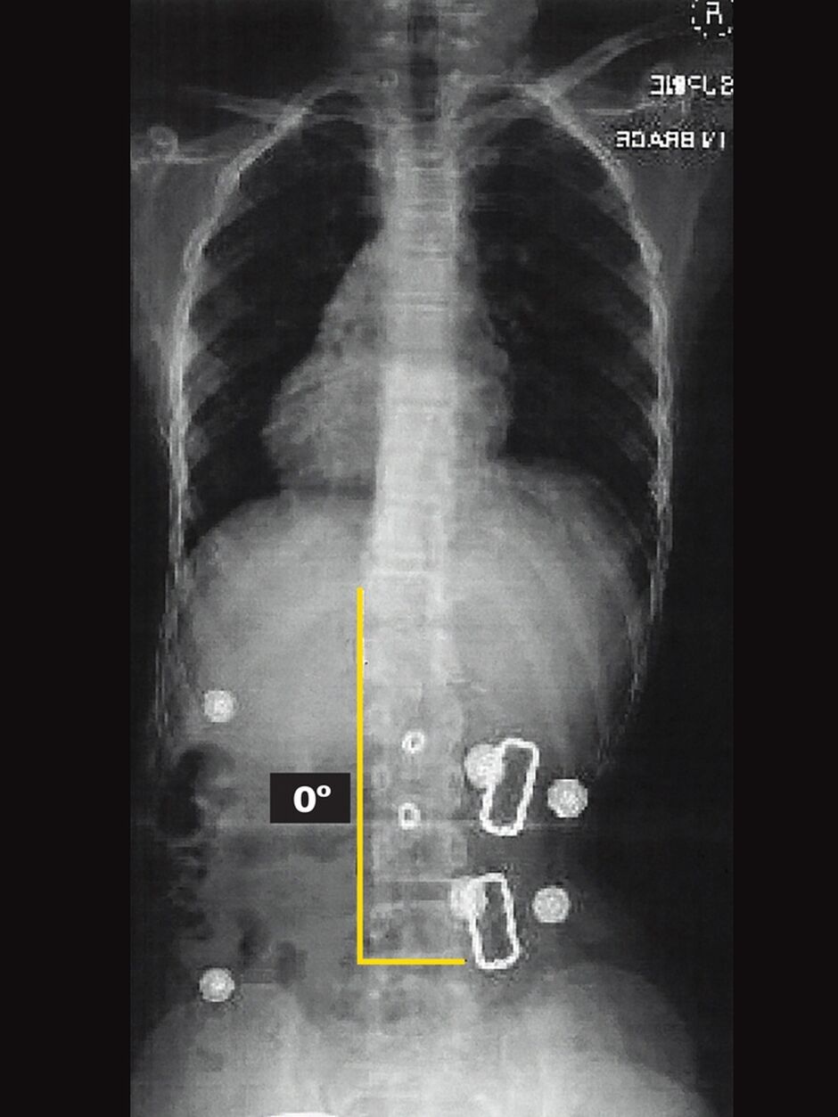 Patient In-Brace X-ray