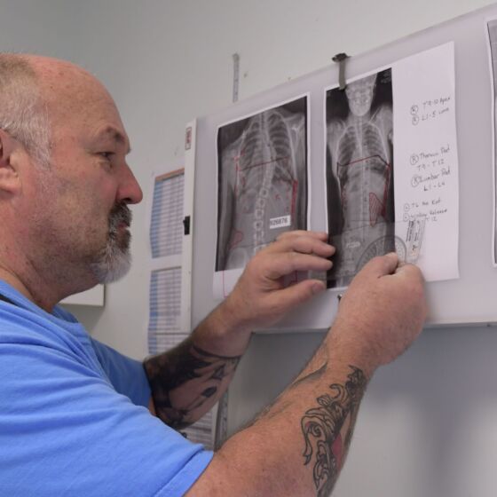 Clinical X-Ray evaluation defines patient brace design