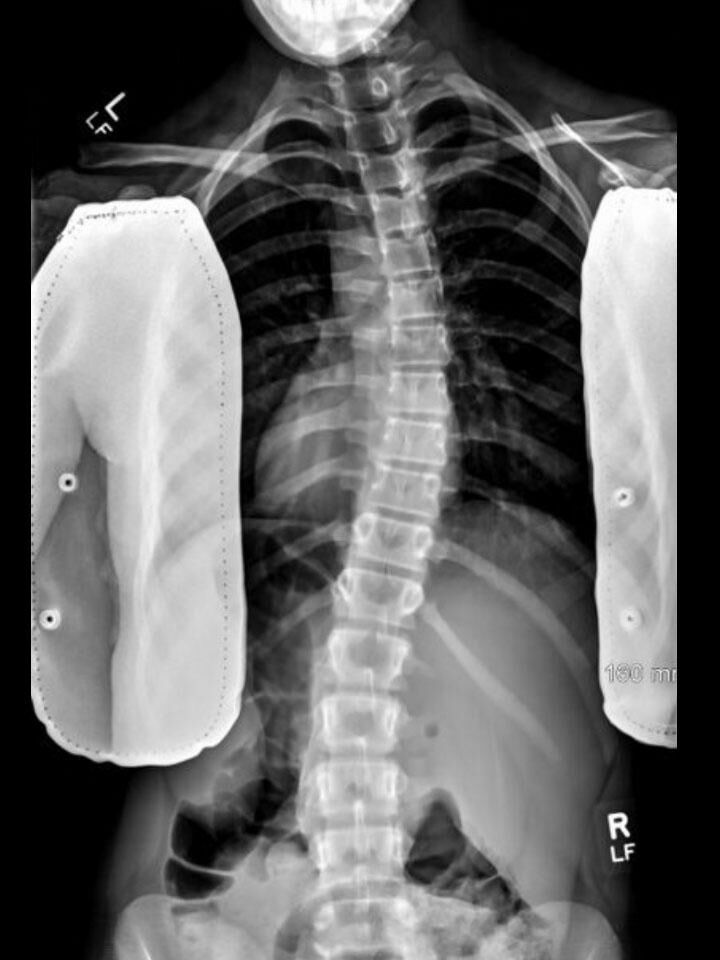 Full-Time X-Ray Set 1 Out of Brace