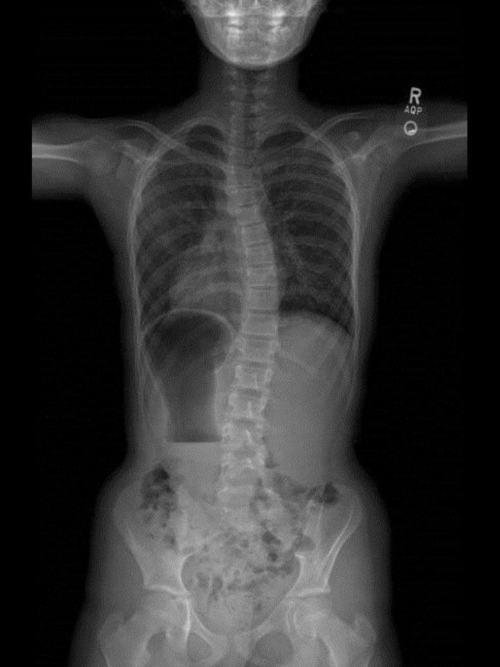 Cloth gusset on a Boston brace: a antero-lateral view, b posterior