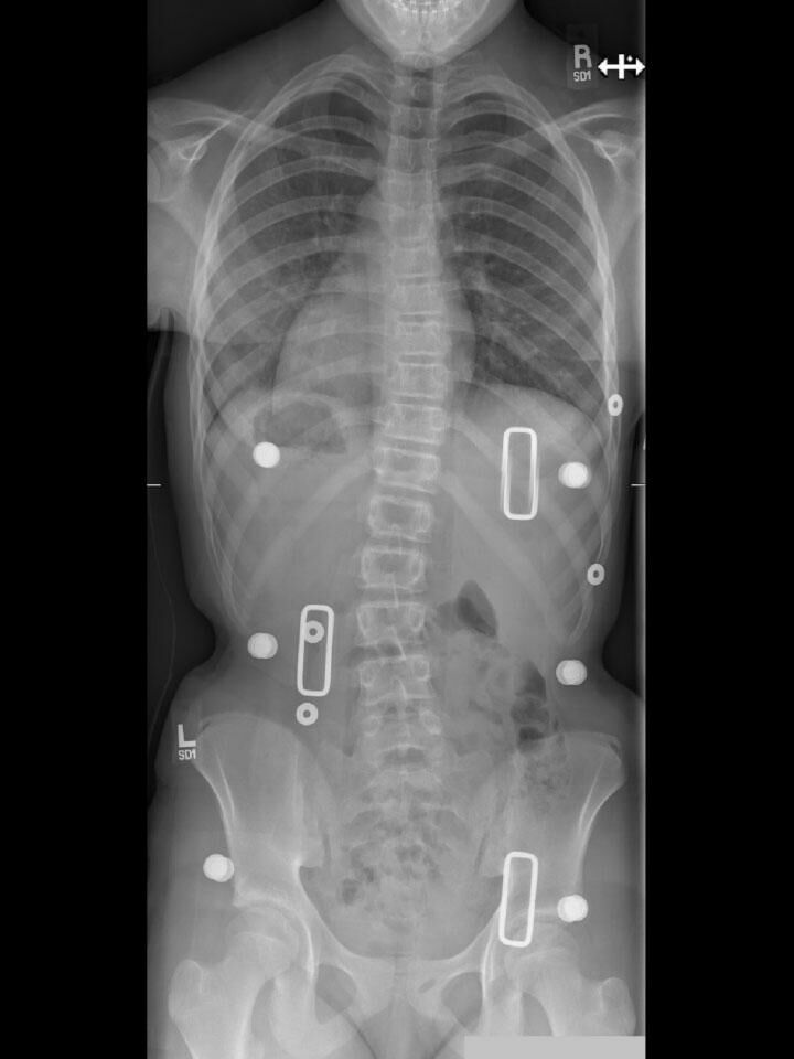 Full-Time X-Ray Set 4 In-Brace