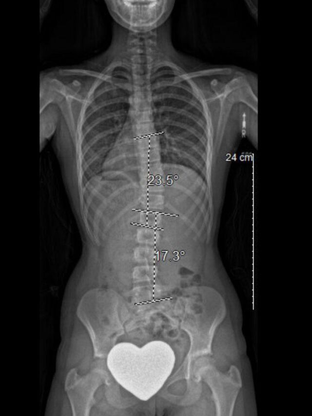 Full-Time X-Ray Set 6 Out of Brace