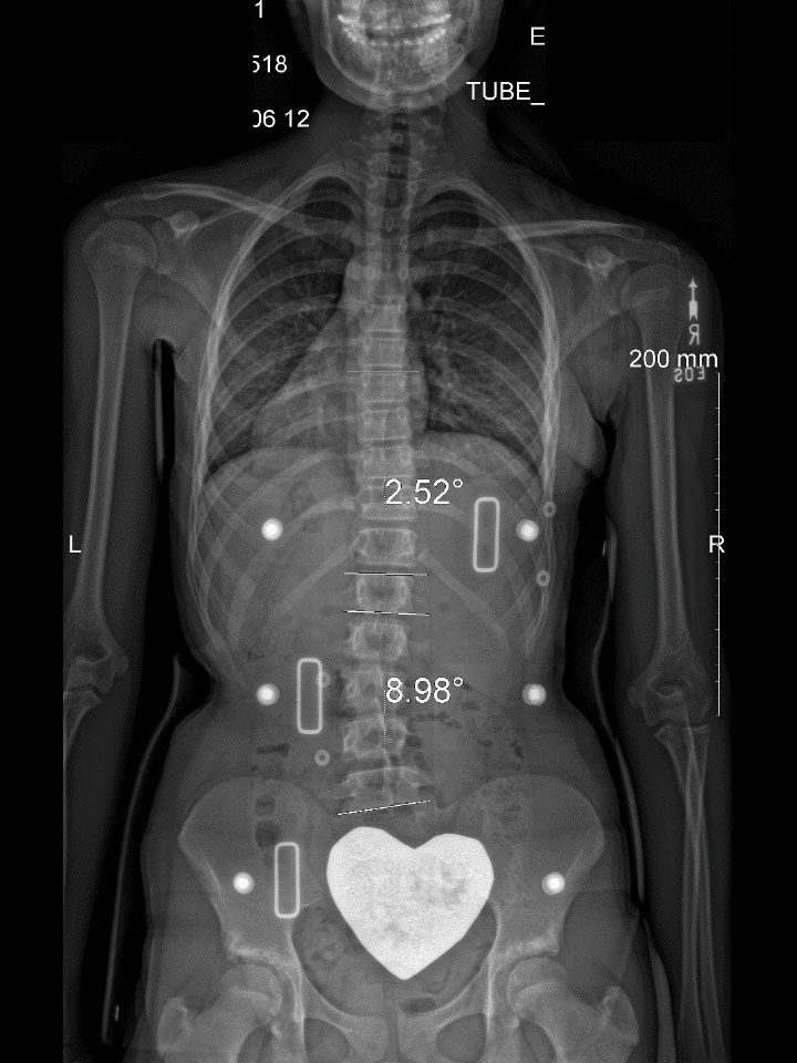 Full-Time X-Ray Set 6 In-Brace