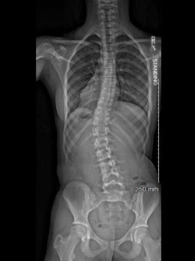Wilmington X-Ray Set 2 Out of Brace