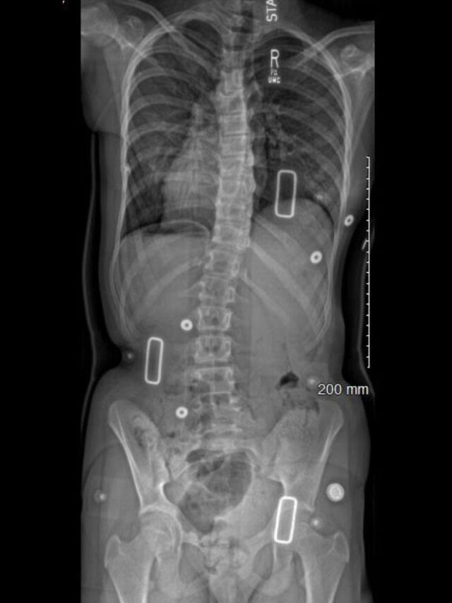 Wilmington X-Ray Set 3 In-Brace