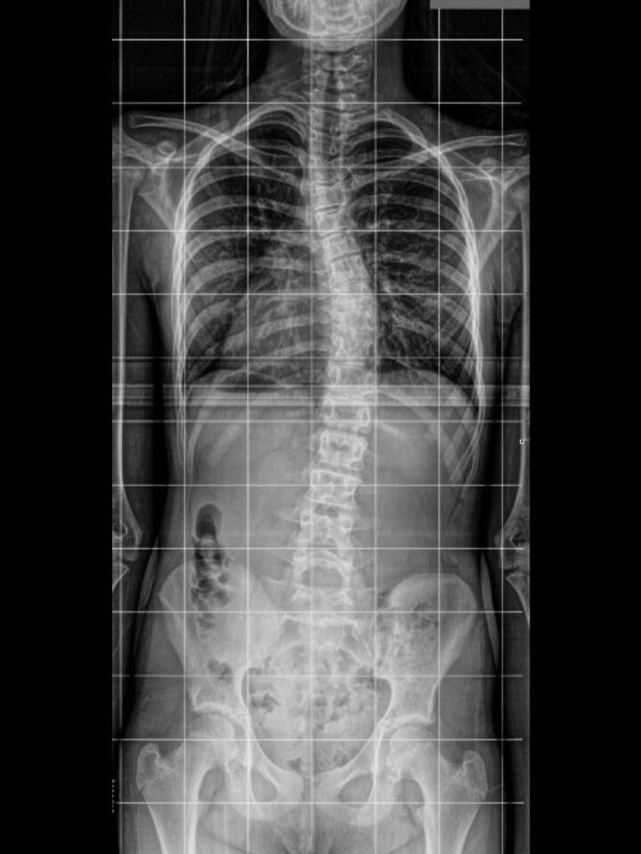 Cheneau X-Ray Set 5 Out of Brace