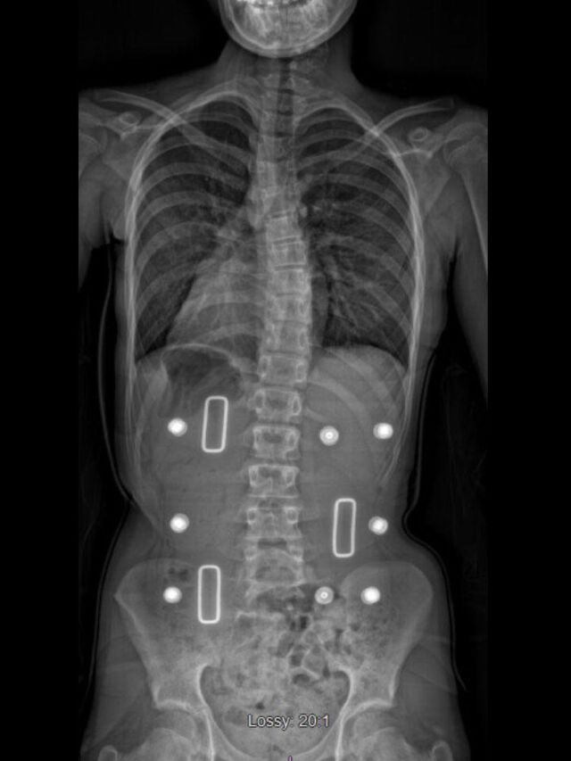 Cheneau X-Ray Set 5 In-Brace