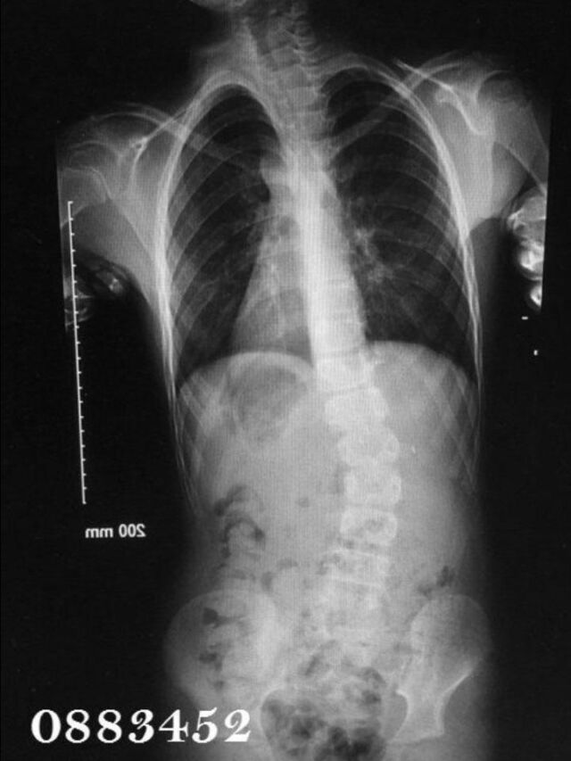 Providence X-Ray Set 1 Out of Brace