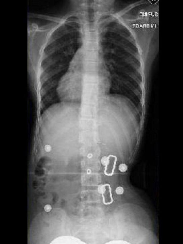 Providence X-Ray Set 1 In-Brace
