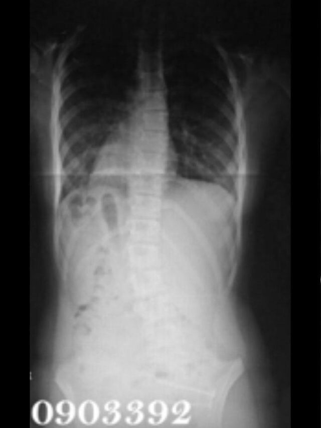 Providence X-Ray Set 2 Out of Brace