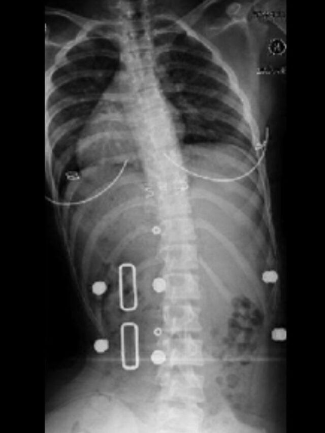 Providence X-Ray Set 2 In-Brace