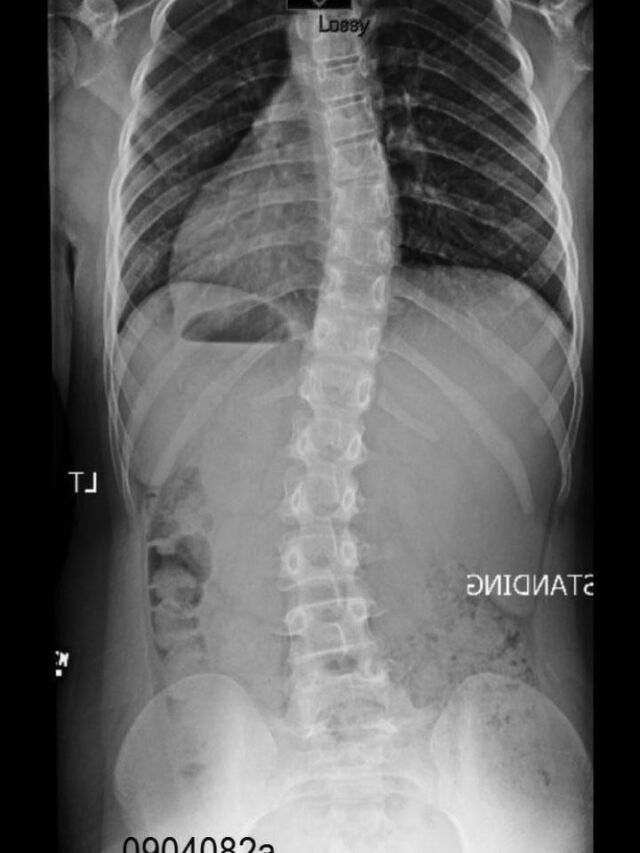 Providence X-Ray Set 3 Out of Brace