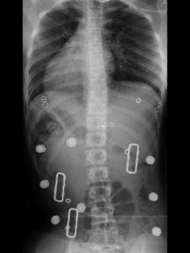Providence X-Ray Set 3 In-Brace