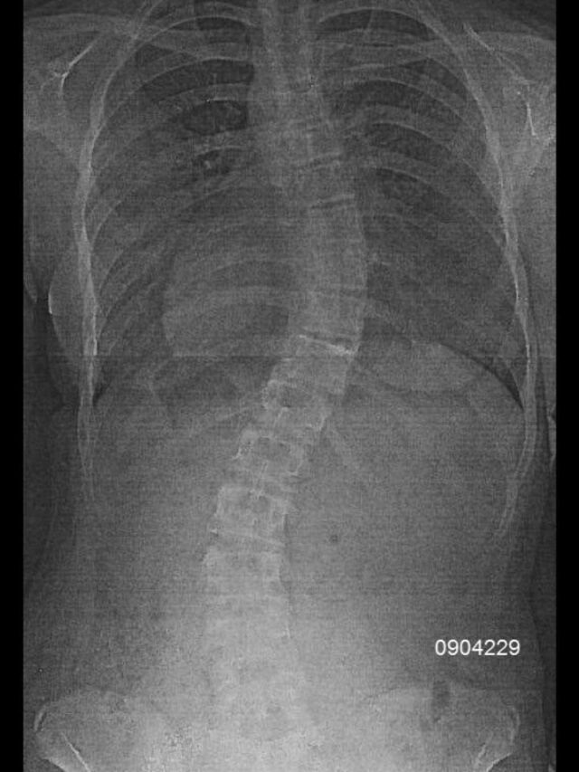 Providence X-Ray Set 4 Out of Brace
