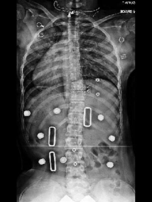 Providence X-Ray Set 4 In-Brace
