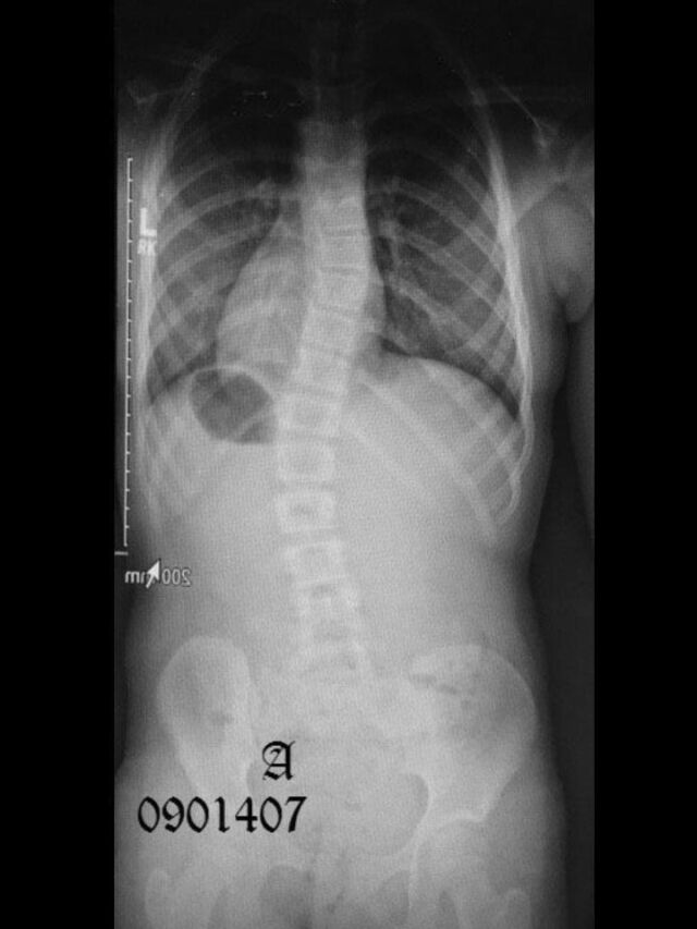 Providence X-Ray Set 5 Out of Brace