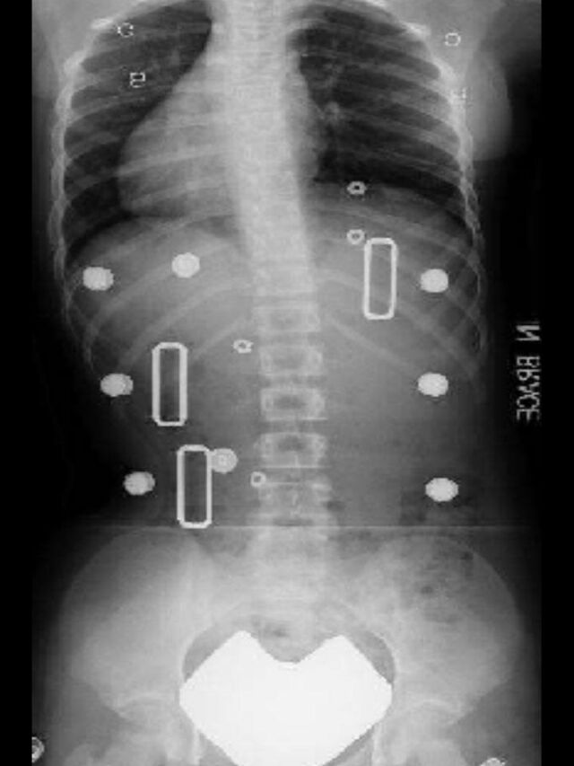 Providence X-Ray Set 5 In-Brace