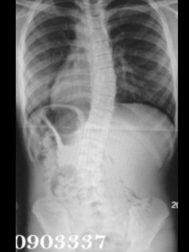 Providence X-Ray Set 6 Out of Brace