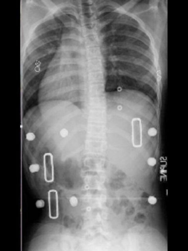 Providence X-Ray Set 6 In-Brace